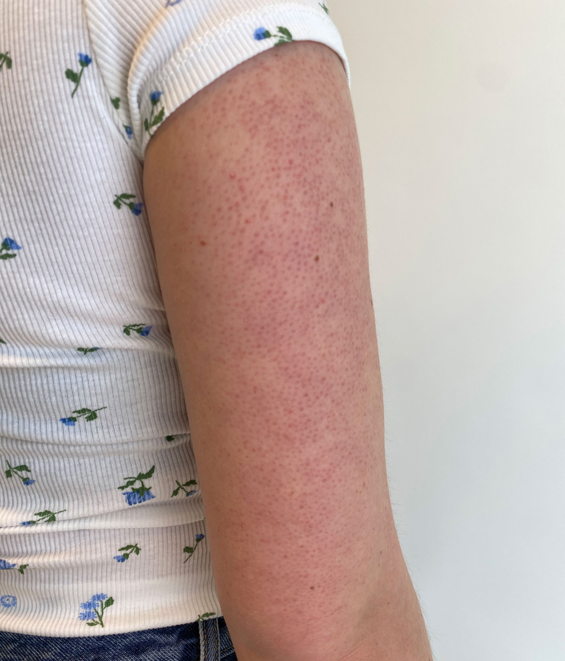 keratosispilaris.jpg